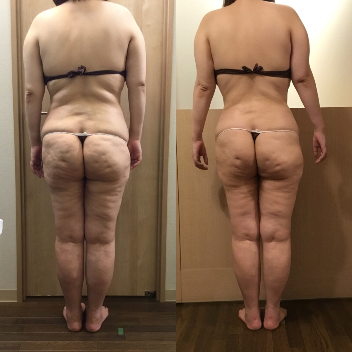 インディバ 4ヶ月間 体質改善 本気痩せ 施術モニター様募集 インディバ専門店 銀座inudiba